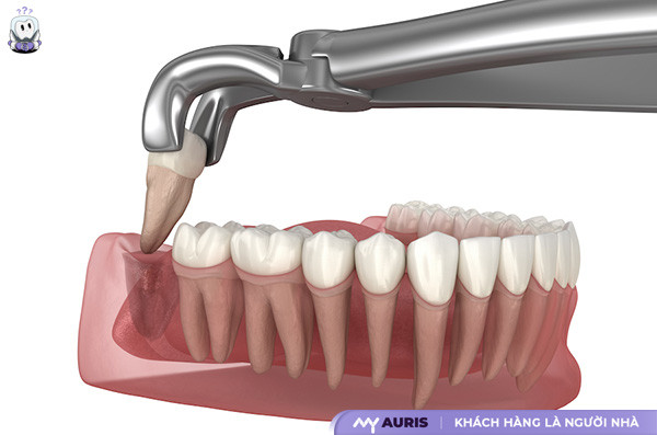 răng số 8,răng số 8 là những răng nào