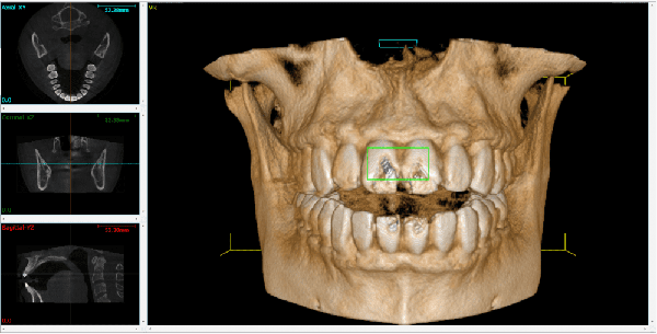Cone Beam CT