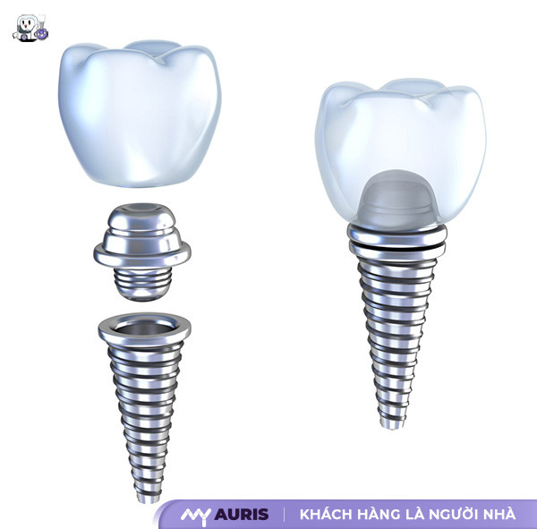 cau-tao-implant-11-4-25-04