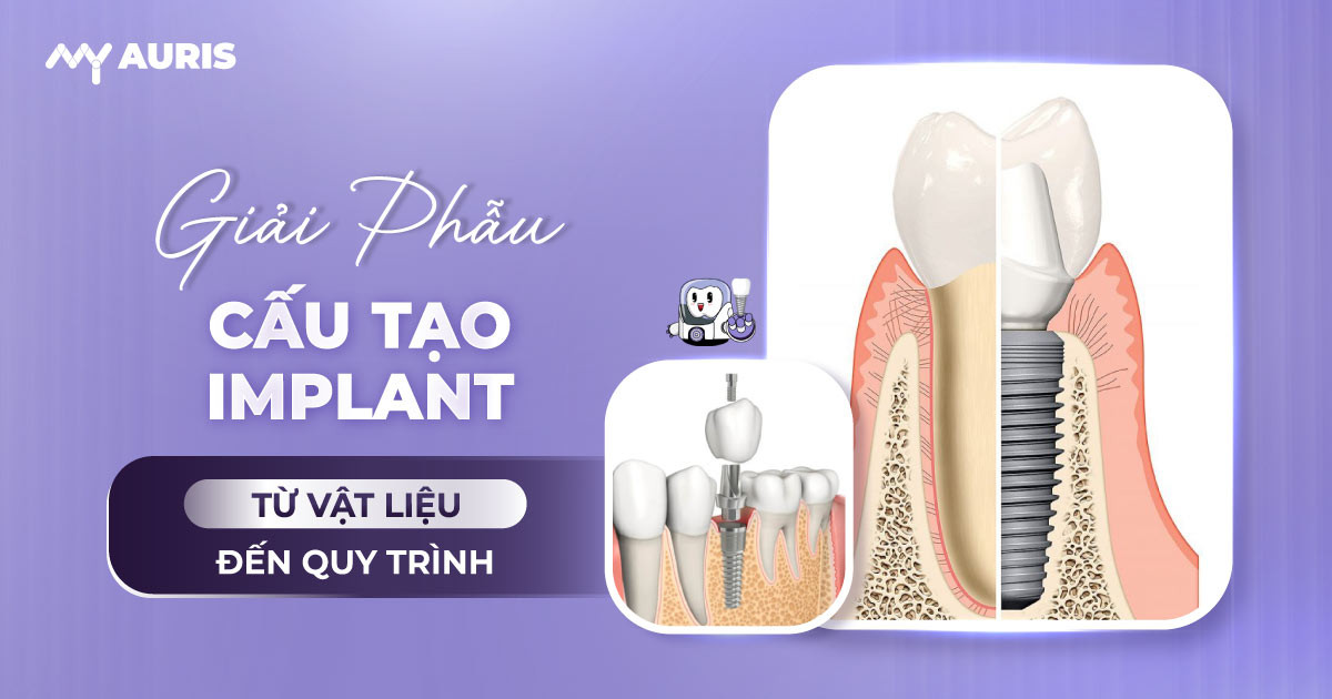cấu tạo implant