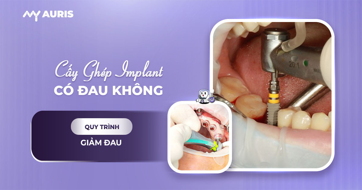 cay-ghep-implant-co-dau-khong-170425-01