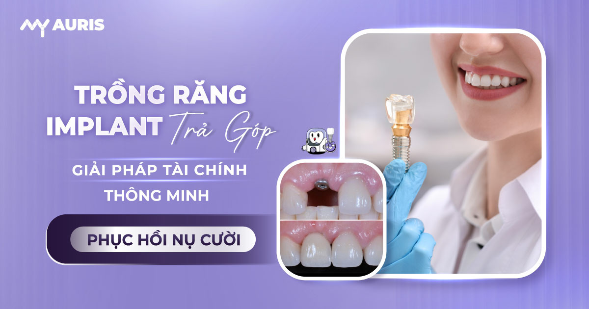 cấy implant trả góp,làm răng trả góp, trồng răng implant trả góp