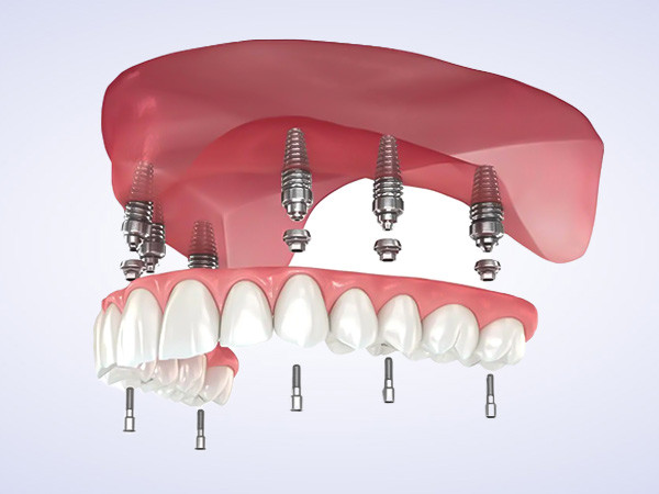 img-implant-nguyen-ham