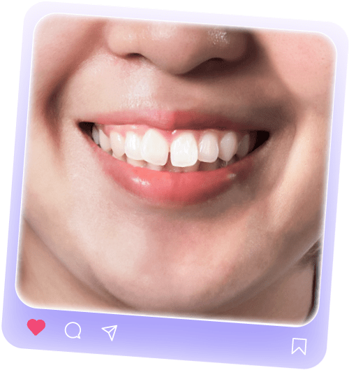 img-nieng-before-min