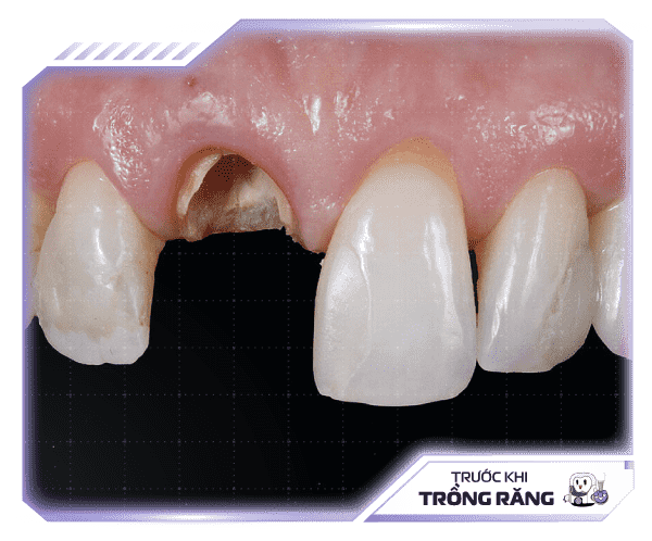 img-truoc-khi-trong-rang-min