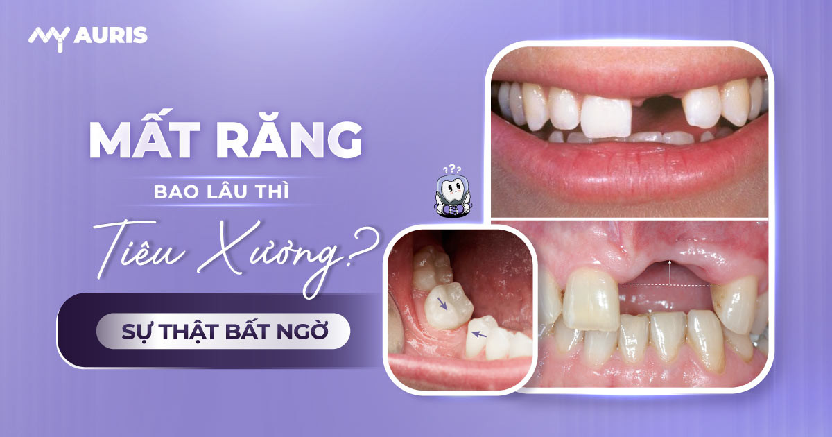 mất răng bao lâu thì bị tiêu xương,mất răng bao lâu thì bị tiêu xương hàm