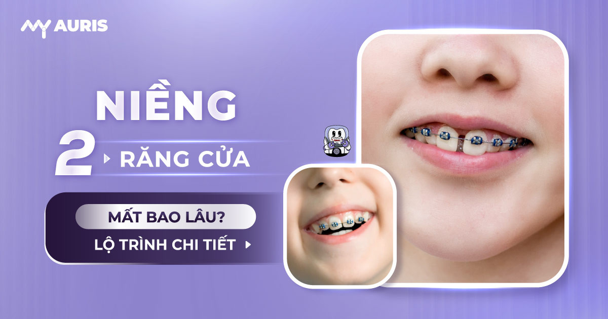 niềng răng cửa