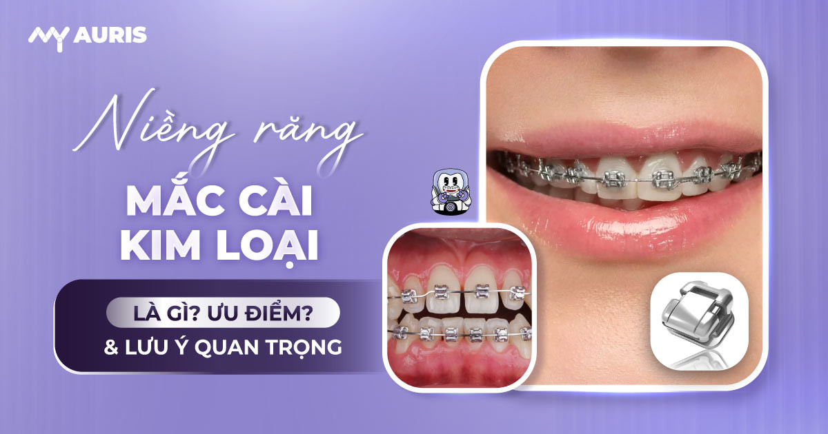 niềng răng mắc cài kim loại