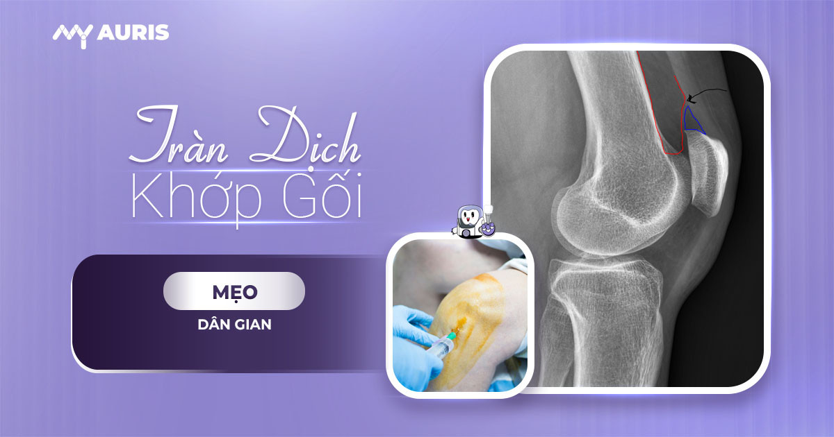 mẹo chữa tràn dịch khớp gối