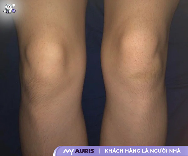 mẹo chữa tràn dịch khớp gối