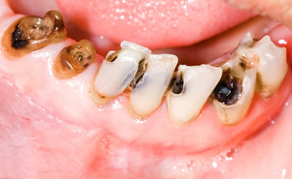 ăn kẹo bị sâu răng,em bé ăn kẹo bị sâu răng