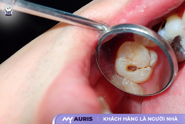 bị sâu răng có đi nghĩa vụ quân sự không