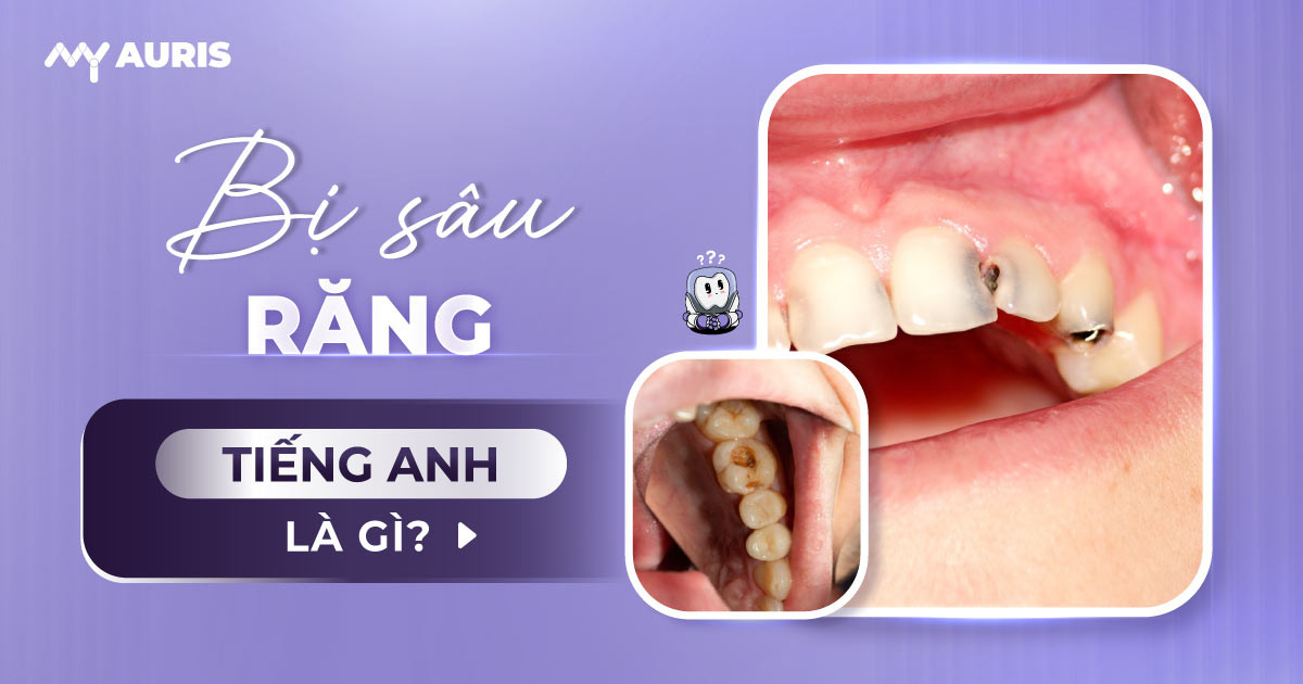 bị sâu răng tiếng anh là gì
