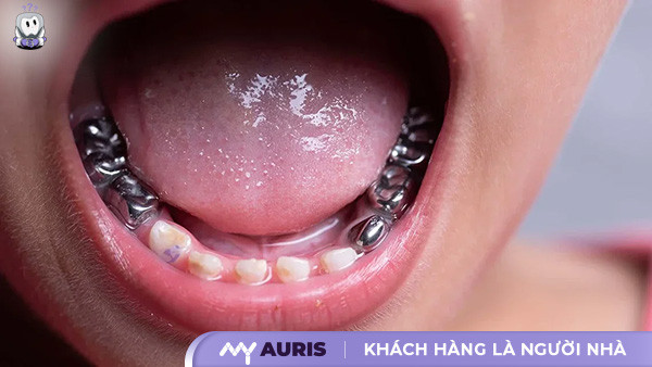 bọc răng inox cho bé