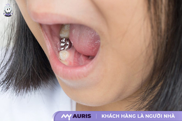 bọc răng inox cho bé