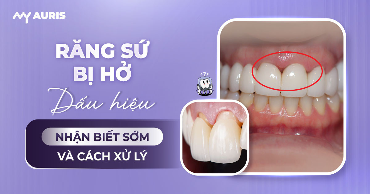 bọc răng sứ bị hở có sao không