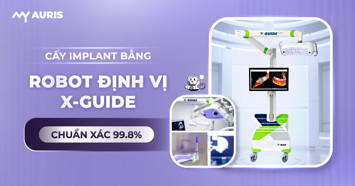 công nghệ cấy ghép implant bằng robot x guide