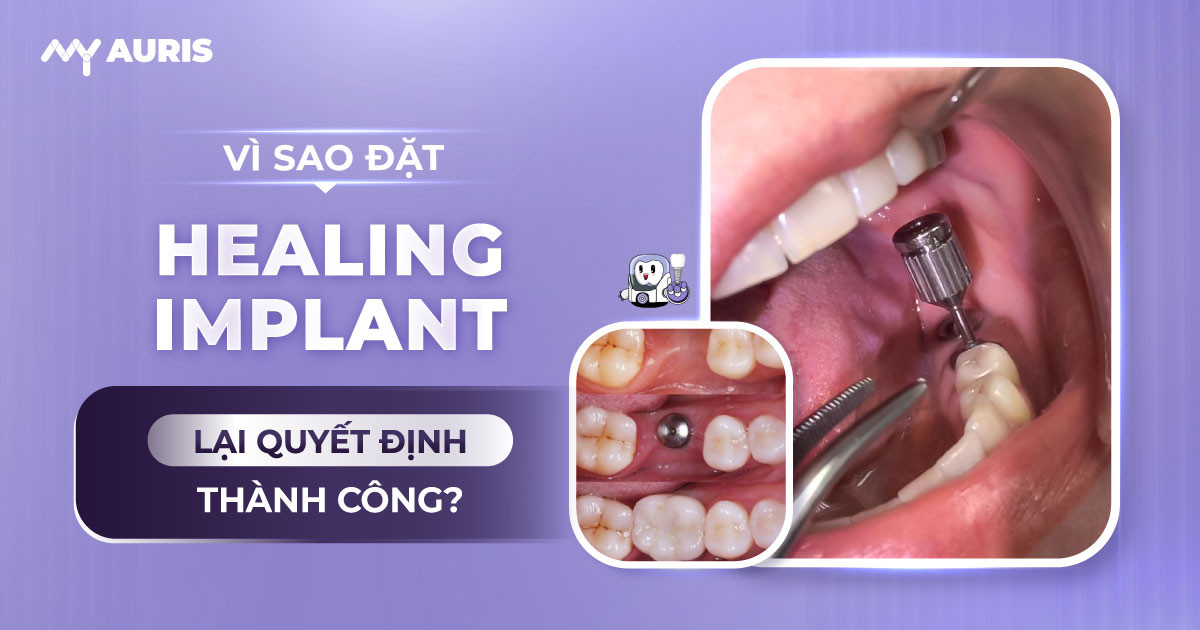 đặt healing implant,đặt implant răng