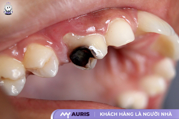 đau răng tiếng anh là gì,đau răng tiếng anh,đau răng trong tiếng anh là gì