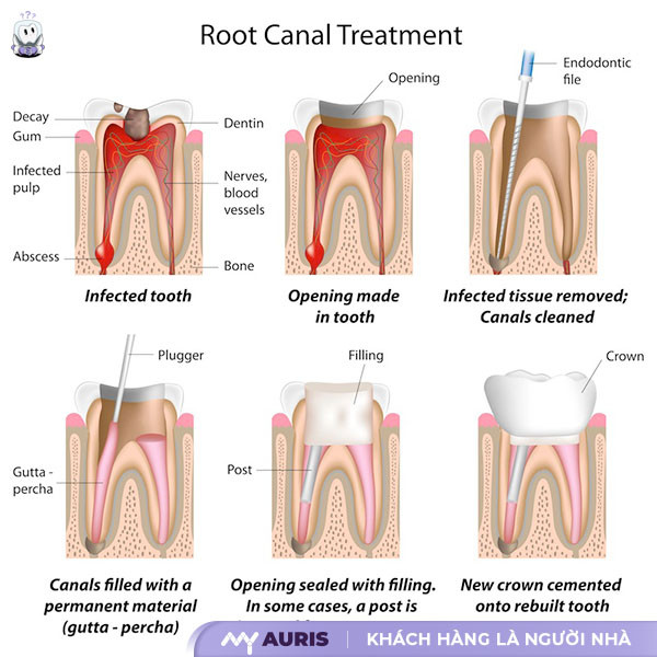 điều trị tủy răng,điều trị tủy răng sữa