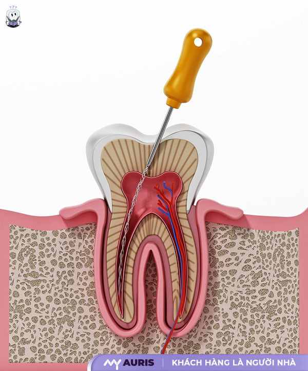 điều trị tủy răng,điều trị tủy răng sữa