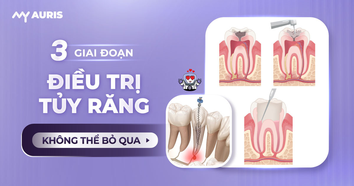 điều trị tủy răng,điều trị tủy răng sữa