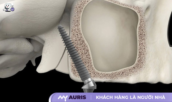 Implant chân bướm