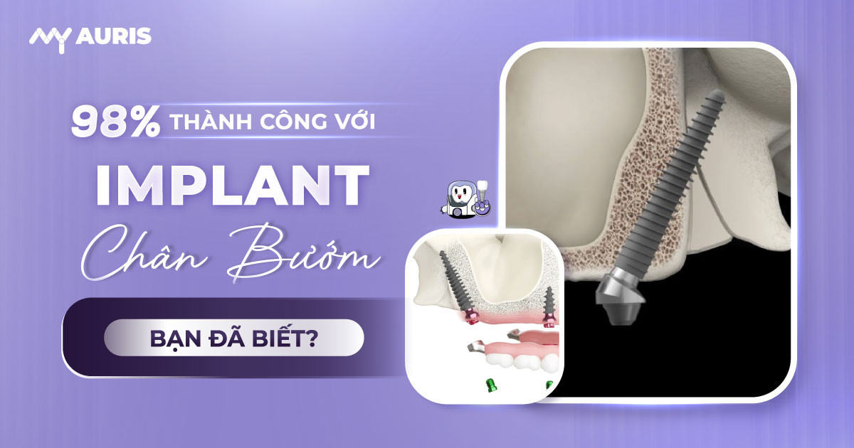 Implant chân bướm