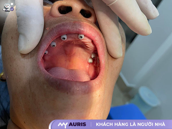 implant cowell