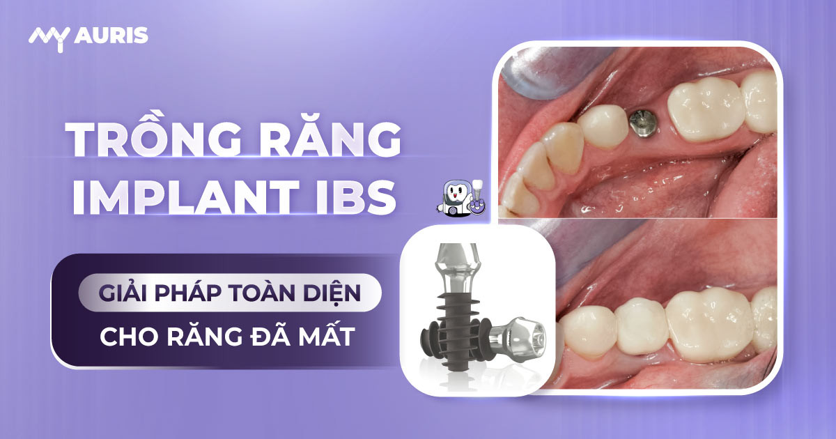 trồng Răng Implant IBS