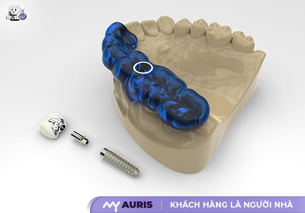 máng hướng dẫn cắm implant