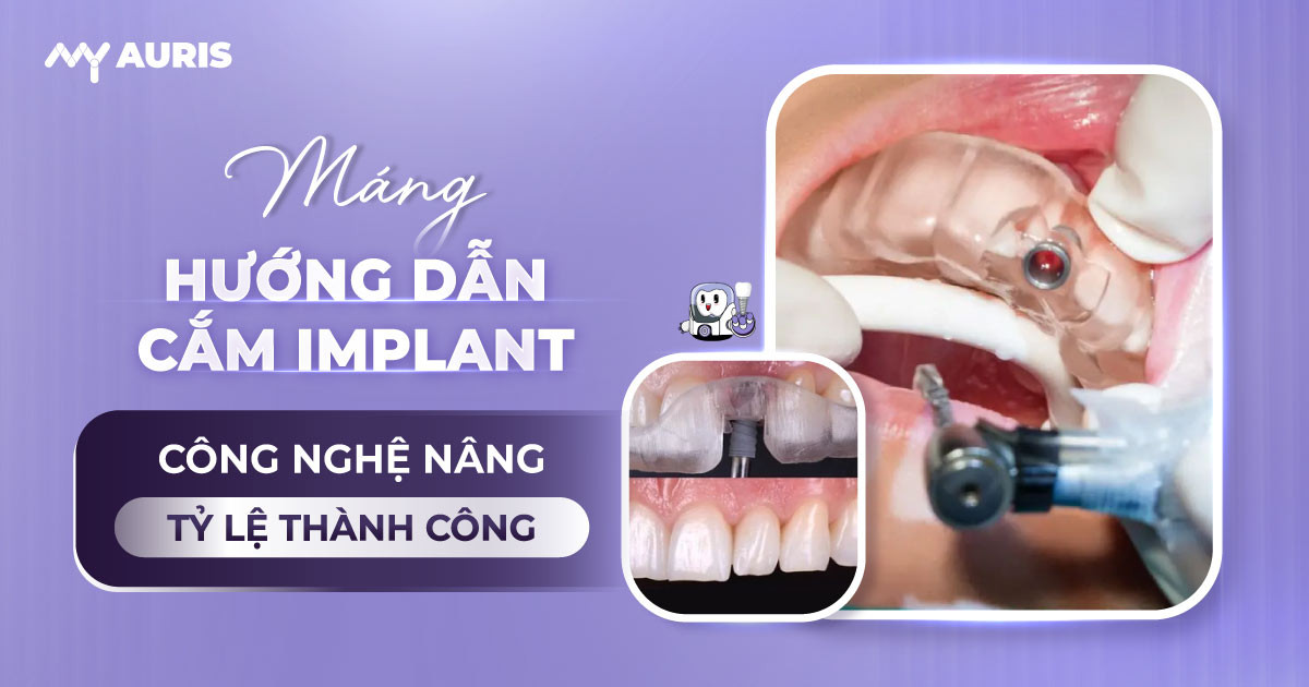 máng hướng dẫn cắm implant