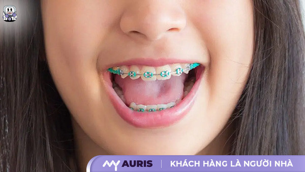 niềng răng cho bé 7 tuổi