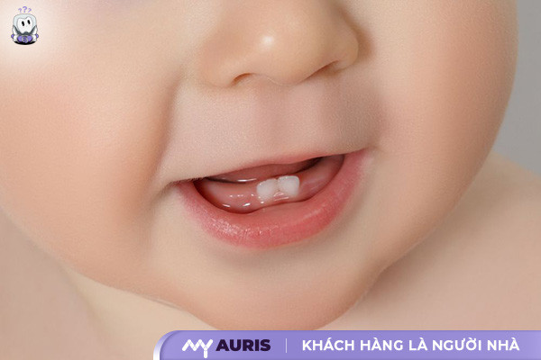 trẻ mọc răng không đúng thứ tự
