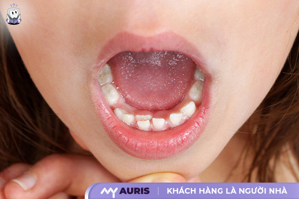 trẻ mọc răng không đúng thứ tự