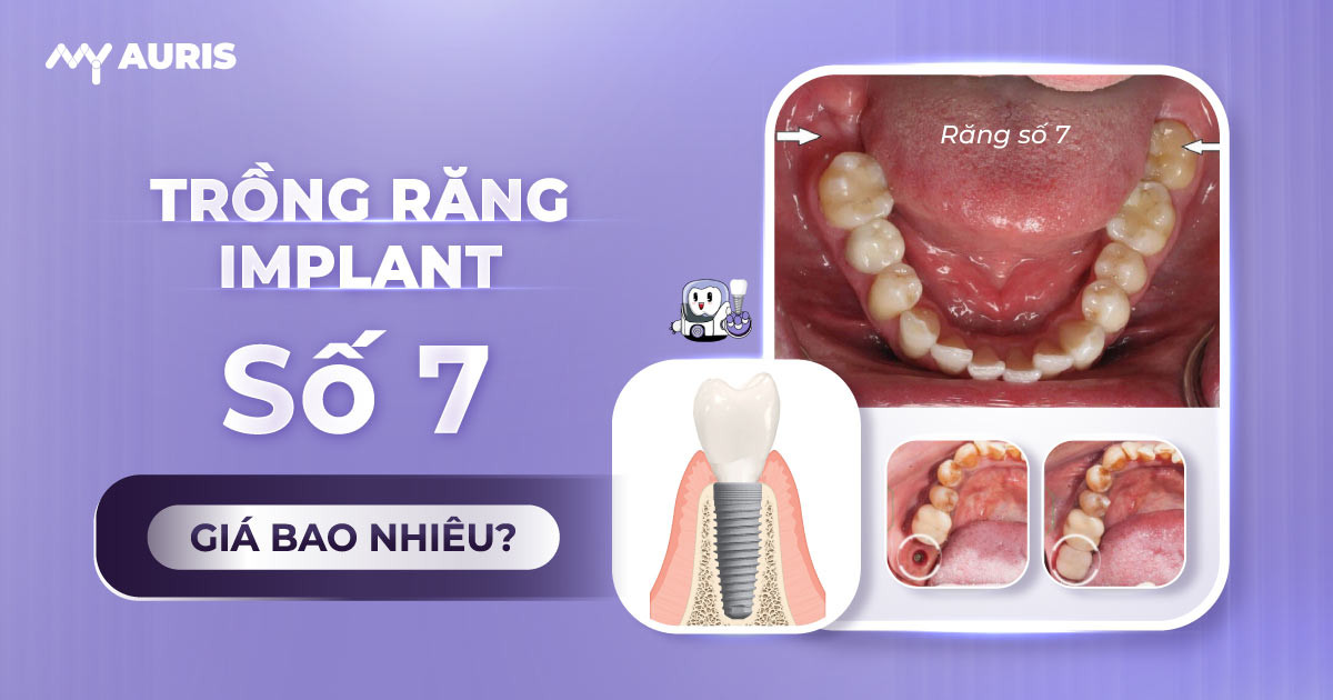 trồng răng số 7 có đau không ,trồng răng Implant số 7 mất bao lâu,có nên trồng răng số 7 không,trồng răng số 7 hàm dưới bao nhiêu tiền,trồng răng số 7 bao nhiêu tiền,trồng răng số 7 mất bao nhiêu tiền,chi phí trồng răng hàm số 7,làm răng giả số 7,trồng răng giả số 7,nhổ răng số 6 có cần trồng lại,nhổ răng số 7 bao lâu thì trồng lại được,nhổ răng số 7 có cần trồng lại không