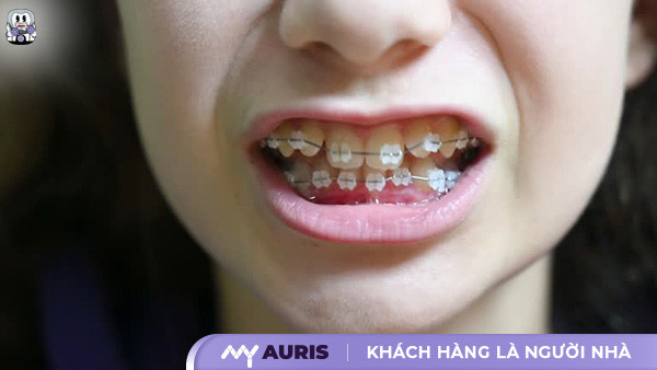 niềng răng có được vĩnh viễn không
