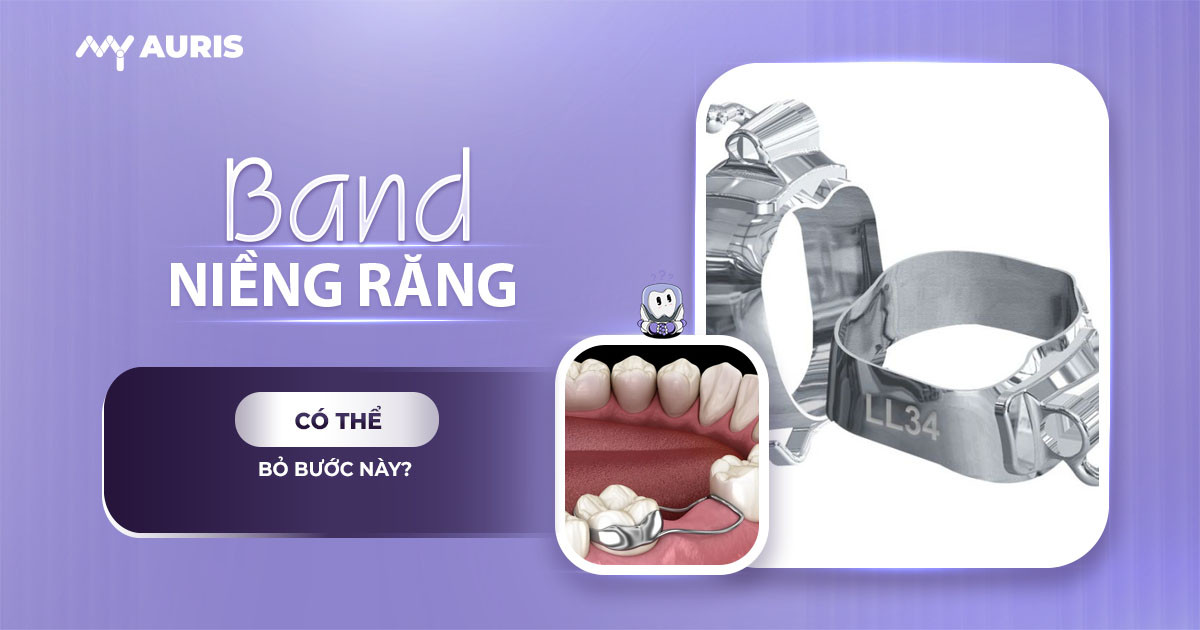 band niềng răng,band răng