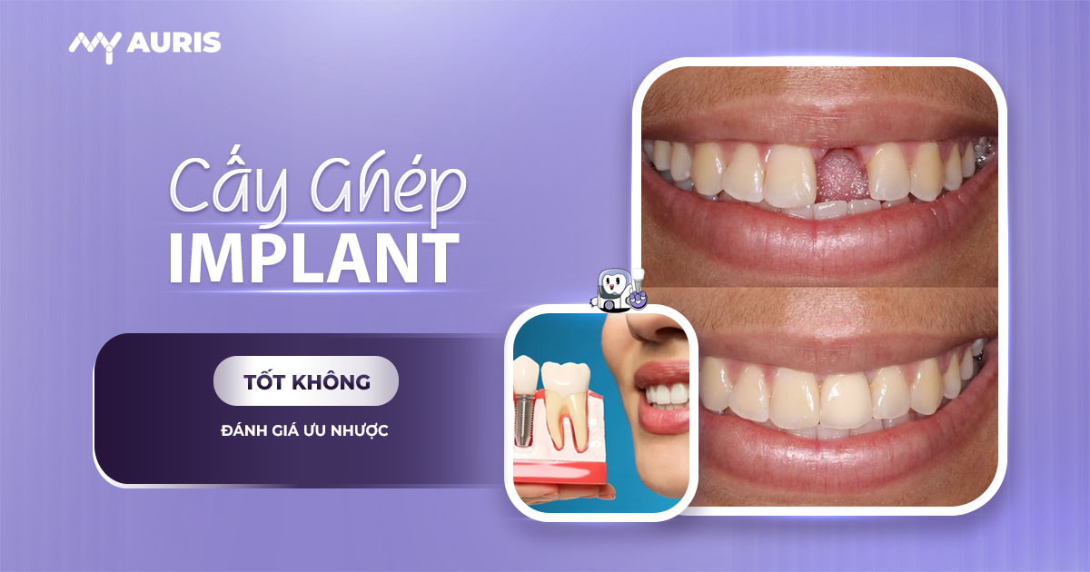 cấy ghép implant có tốt không,cấy ghép răng implant an toàn