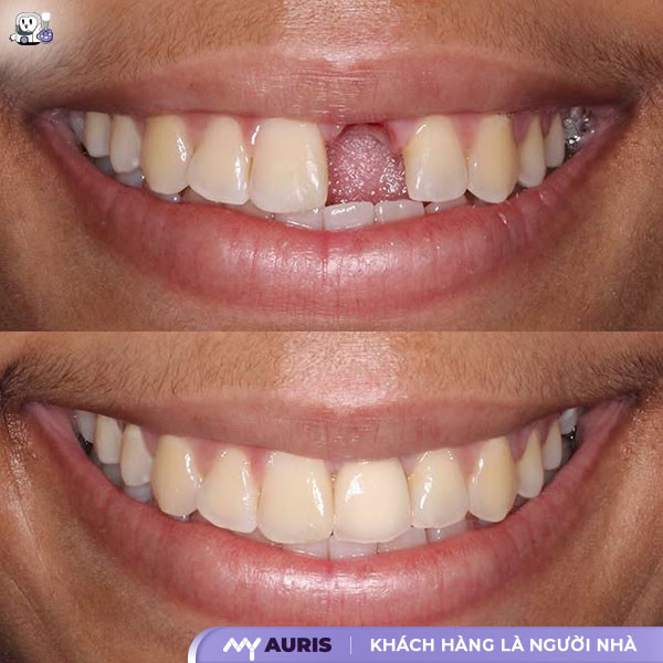 cấy ghép implant có tốt không,cấy ghép răng implant an toàn