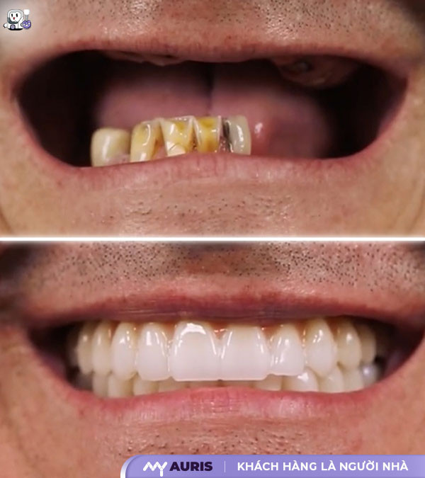 cấy ghép implant có tốt không,cấy ghép răng implant an toàn