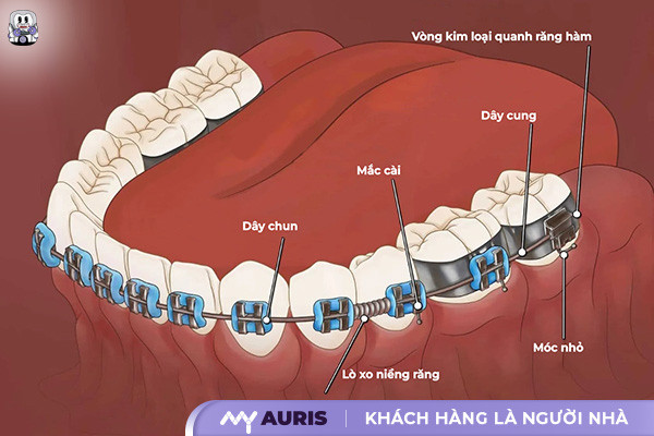 xoay răng trong niềng răng,cơ chế di chuyển răng trong niềng răng
