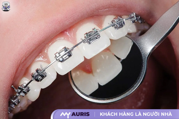 niềng răng có được vĩnh viễn không