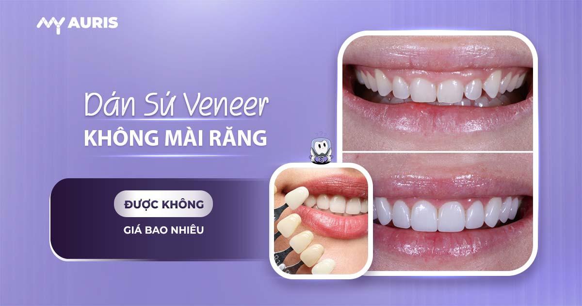dán sứ có mài răng không,răng sứ veneer,mặt dán sứ veneer không mài răng,dán sứ veneer không mài răng
