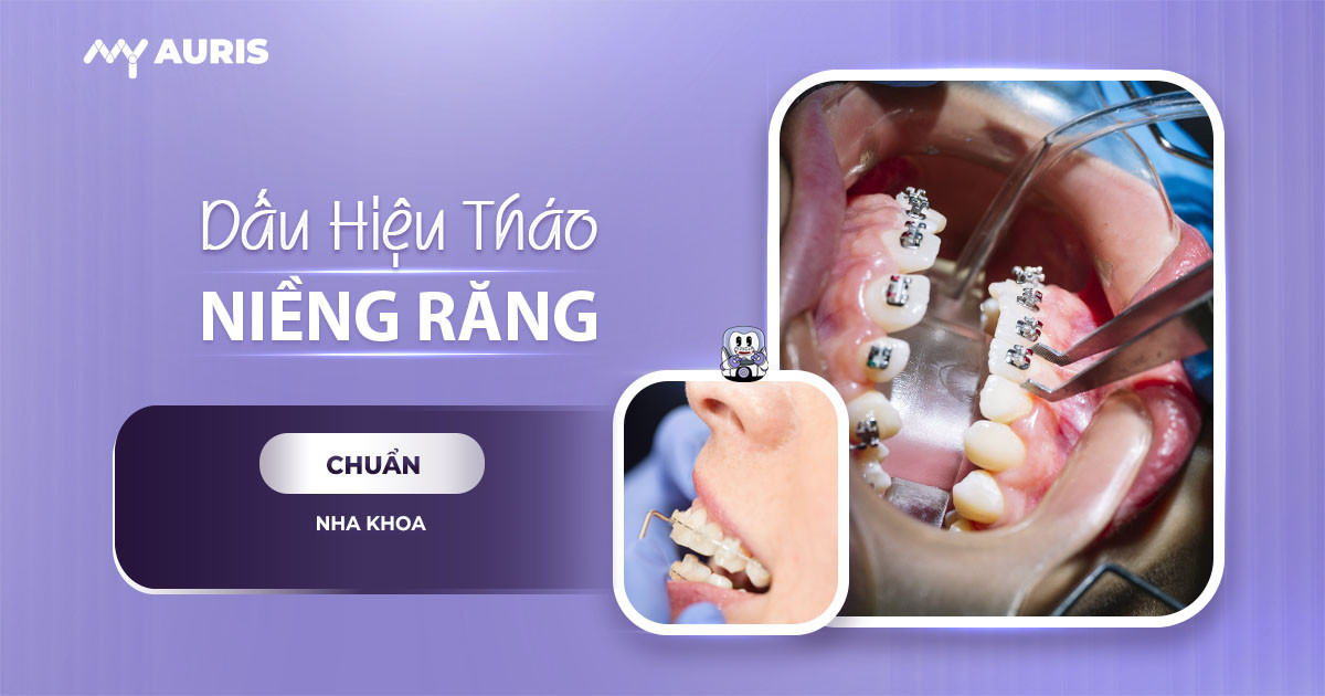 dấu hiệu sắp tháo niềng răng