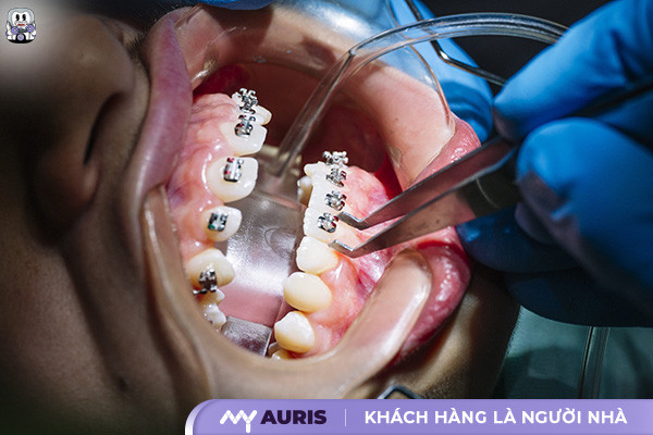 dấu hiệu sắp tháo niềng răng