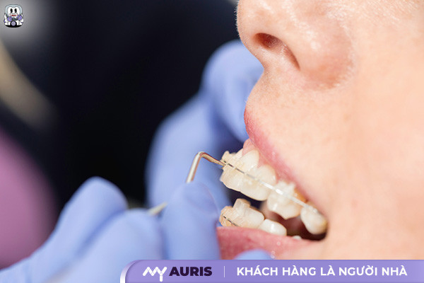 dấu hiệu sắp tháo niềng răng