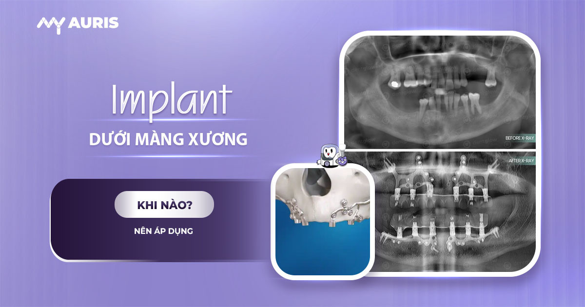 implant dưới màng xương