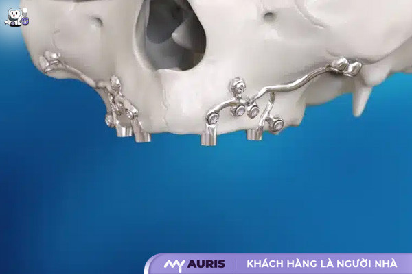 implant dưới màng xương