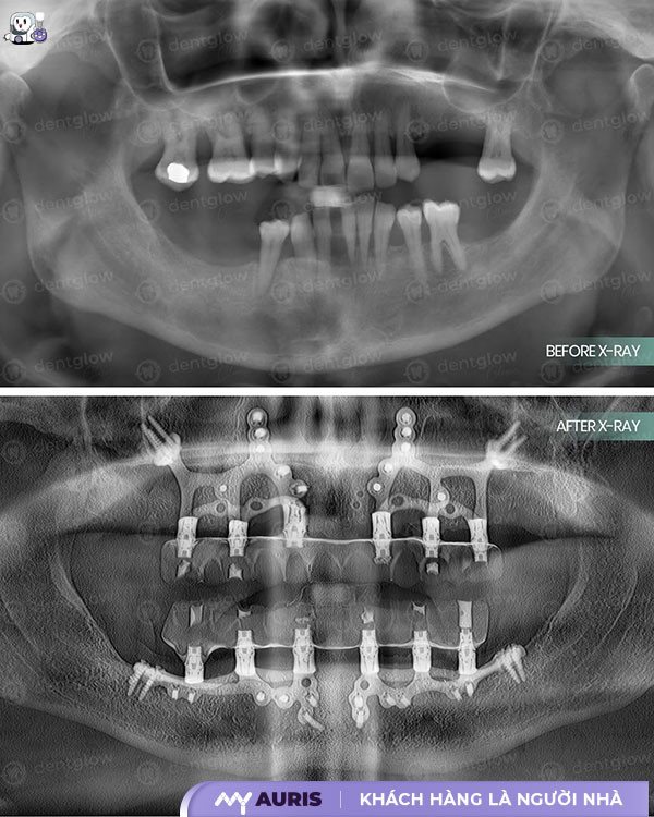 implant dưới màng xương